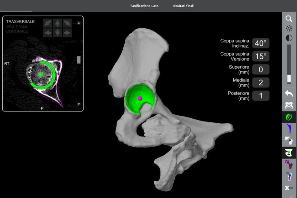 chirurgia robotica anca come si svolge l'intervento - Dr. Riccardo Giacomi protesi d'anca per via anteriore 